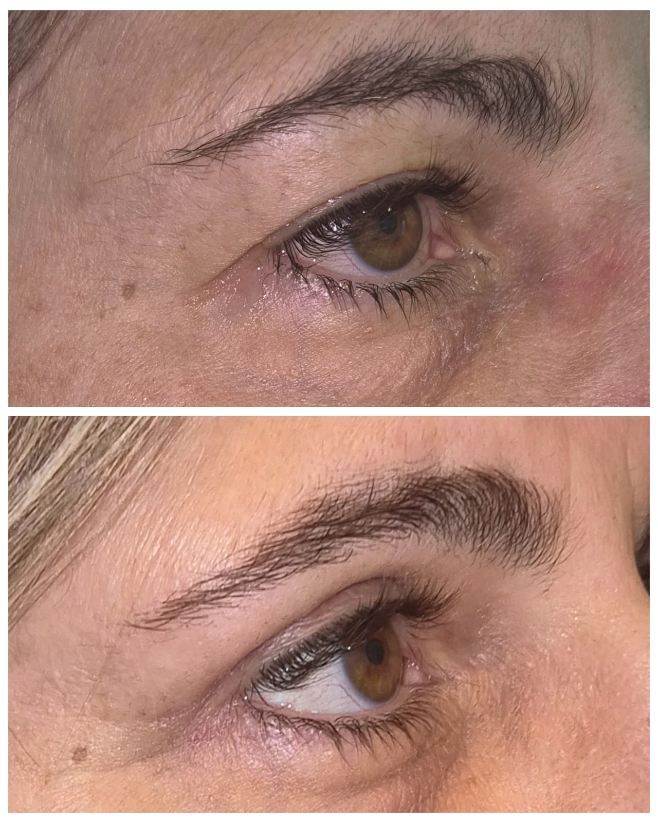 Antes e depois de blefaroplastia 8